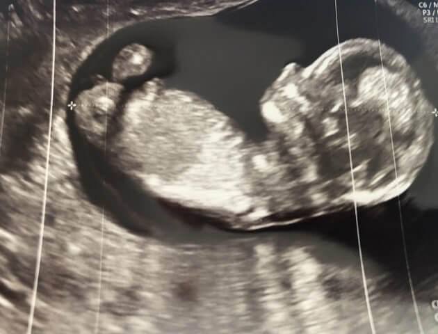 妊娠11週目の超音波写真を撮影した写真