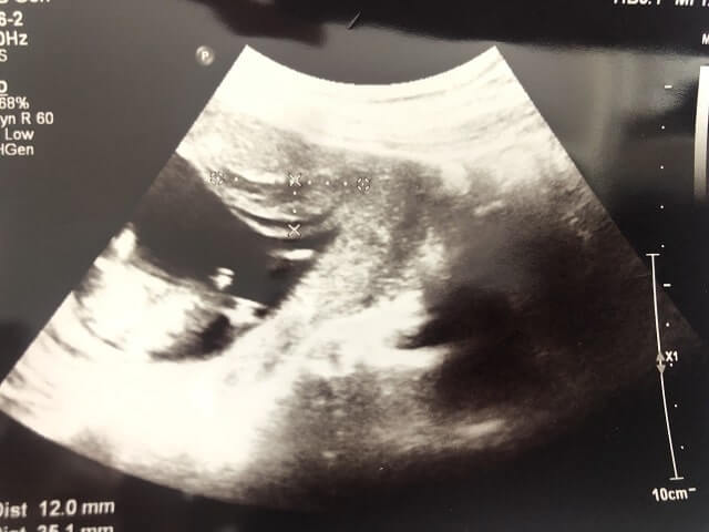 胎盤の一部が剥離した超音波写真を撮影した写真